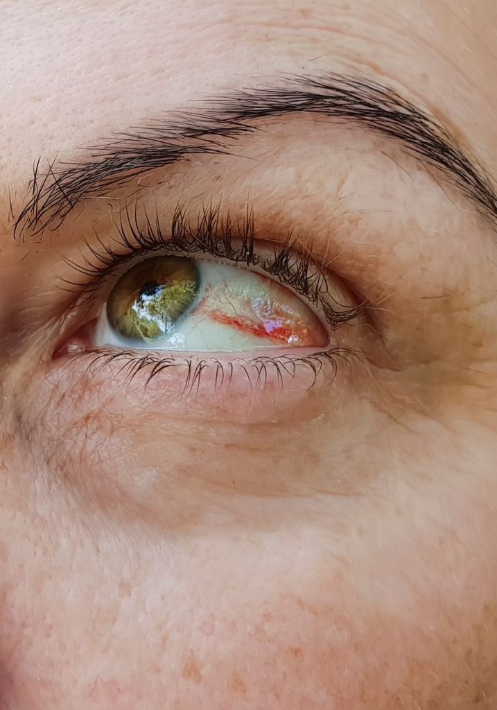 Diabetic Retinopathy